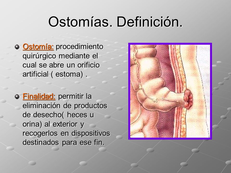 ¿que es una ostomia?